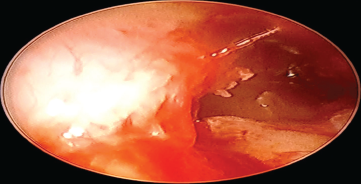 Eustachian tube and middle ear pressure.