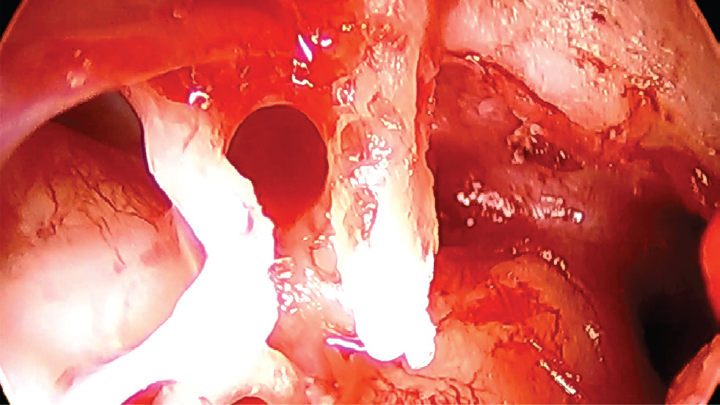Epitympanic diaphragm.