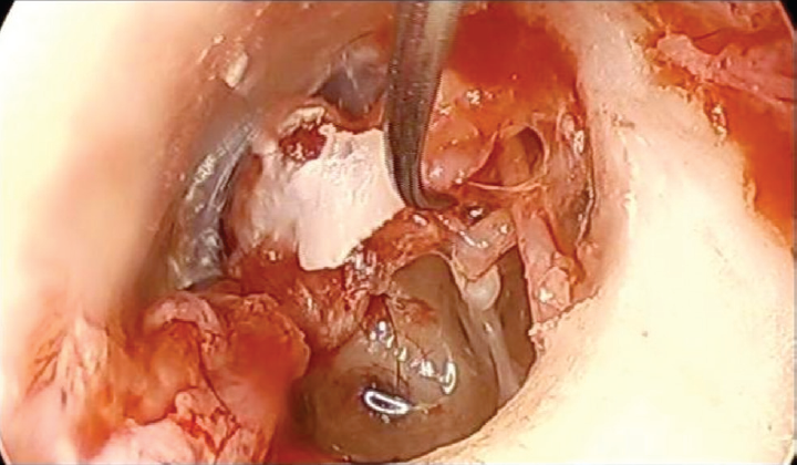 Lateral incudomalleolar ligament (LIML).