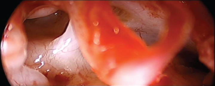 Anterior tympanic isthmus.