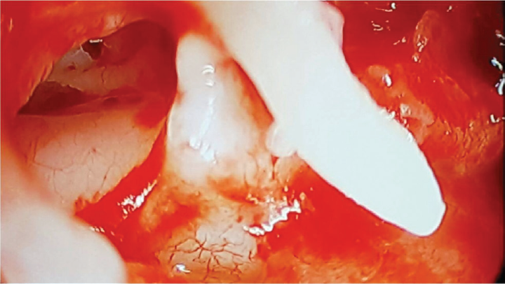 Anterior tympanic isthmus (magnified view).