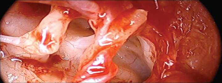 Posterior tympanic isthmus.