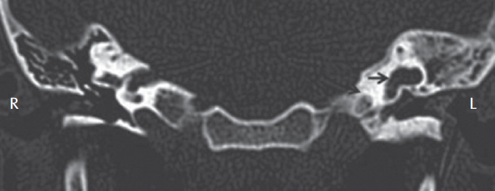 High-resolution coronal CT scan showing common cavity defect with no definable partitions (arrow). CT, computed tomography; L, left; R, right.