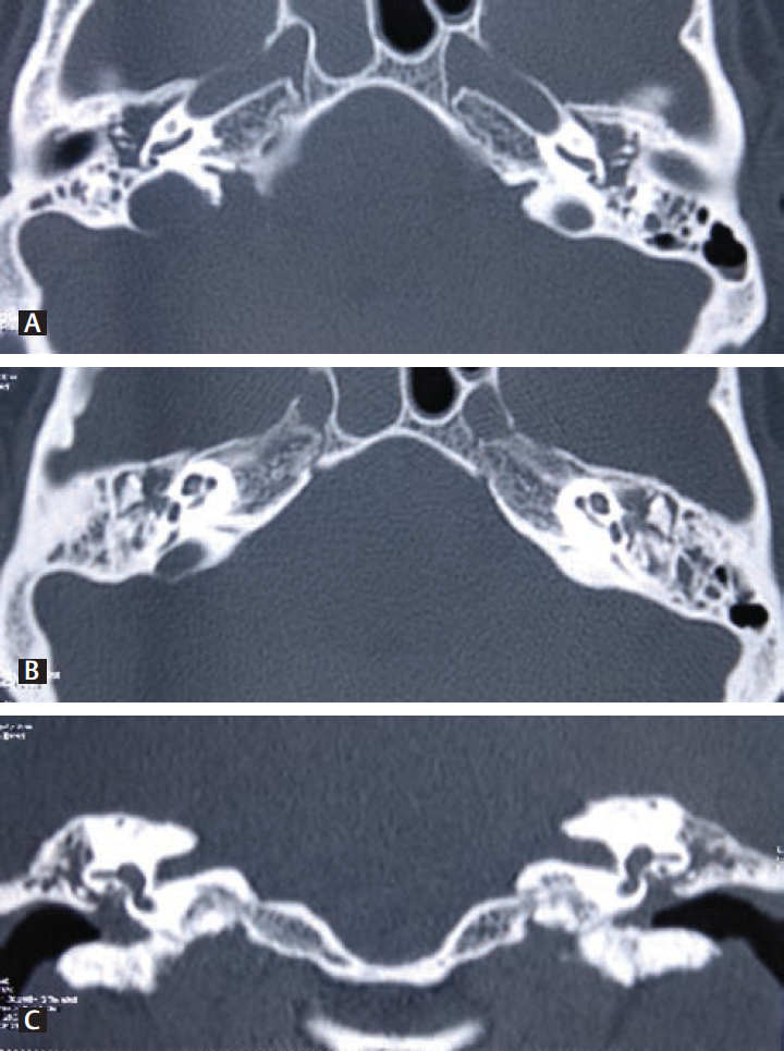 High-resolution computed tomography temporal bone showing soft tissue in middle ear (A), epitympanum and partly in mastoid cavity with mastoid septa intact (B, C).