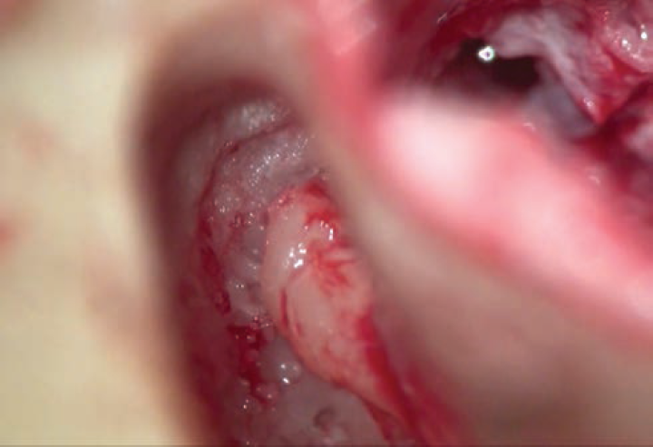 Granulations cleared (epitympanotomy).