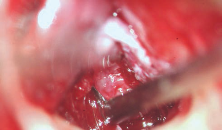 Extensive granulations in ME. ME, middle ear.