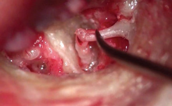 Intact ossicular chain after complete clearance of granulations.
