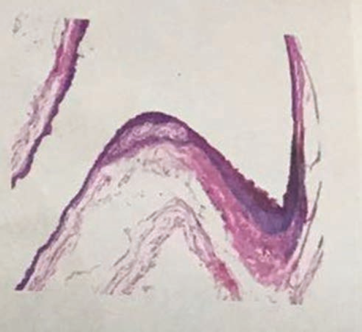 Histopathological picture of biopsy of middle ear granulations.