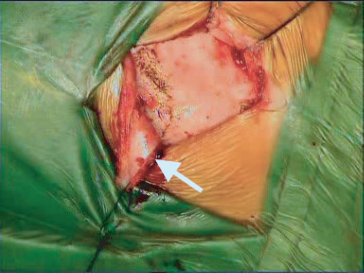 Image showing posterosuperiorly raised musculoperiosteal flap (white arrow).