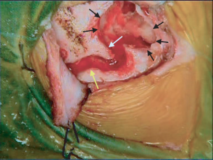 Image showing electrode exit channel (yellow arrow), hook to hitch electrode array (white arrow), and overhang over the edges of the mastoid cavity (black arrows).