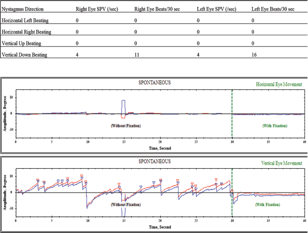 Spontaneous vertical down-beating nystagmus due to lamotrigine. SPV, slow-phase velocity.