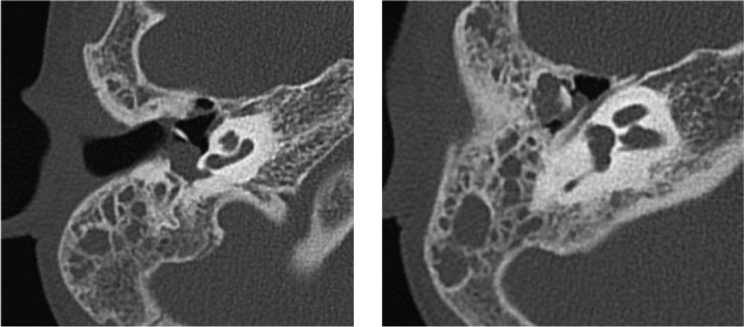 Axial HRCT of the temporal bones demonstrating opacification of the right mesotympanum and epitympanum (white arrows), with absent long process of the incus and erosions in the body and short process of incus (black arrow). HRCT, high-resolution computed tomography.