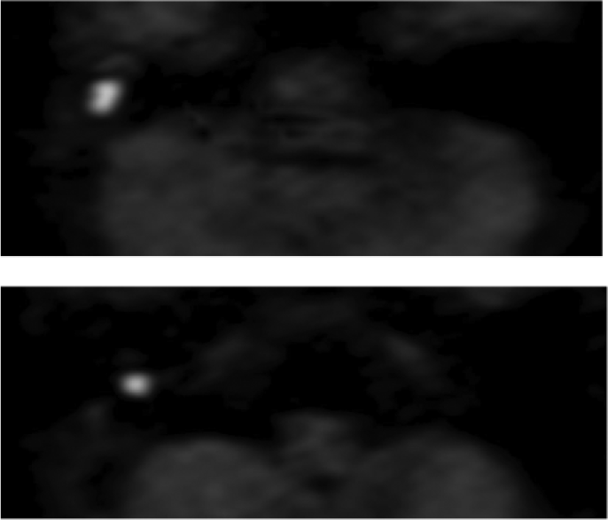 Axial non-EPI DWI (T2 HASTE) demonstrating large areas of restricted diffusion, seen as bright foci in the right middle ear and mastoid (white arrows) compatible with cholesteatoma. EPI DWI, echo-planar imaging diffusion-weighted imaging. HASTE, half-Fourier acquisition single-shot turbo.