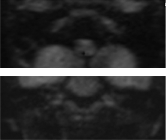 Axial and coronal non-EPI DWI (T2 HASTE) at the 2-year follow-up demonstrating no foci of restricted diffusion in the right middle ear and mastoid. EPI DWI, echo-planar imaging diffusion-weighted imaging.