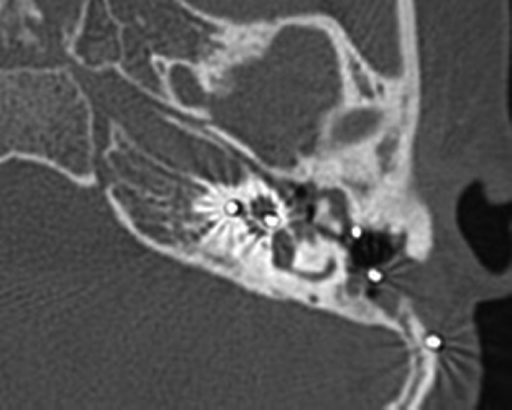 Disease in middle ear and attic with implant in situ in group A.