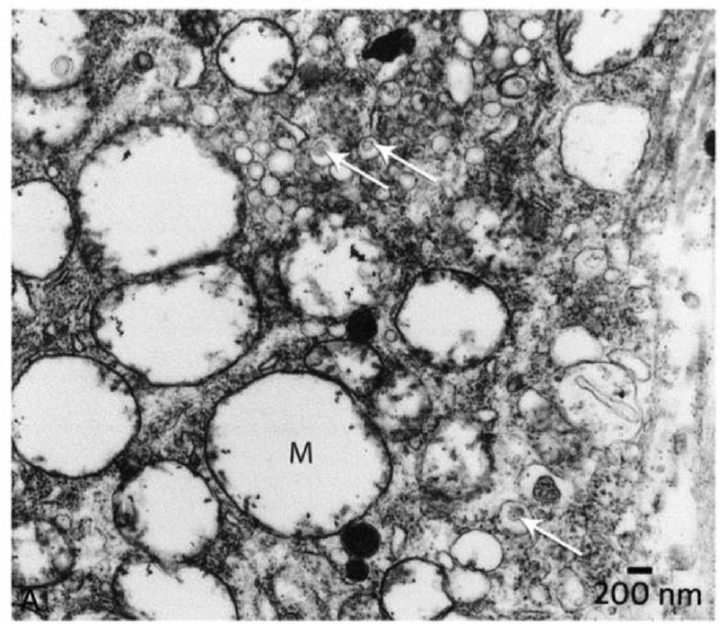 Electron microscope) view of ganglion cell from a patient. Arrows point to virus particles enclosed in transport vesicles. Mag = 13,000×.