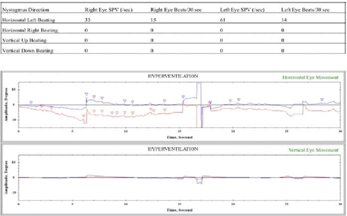 VNG showing hyperventilation-induced nystagmus. SPV, slow phase velocity; VNG, videonystagmography.