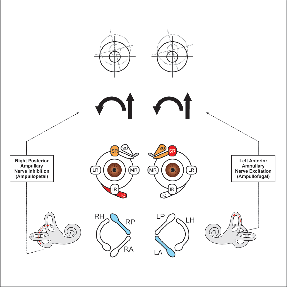 In the right Dix–Hallpike position, there is an ampullofugal shift of otoconial debris in the ampullary arm of the left anterior semicircular canal, which generates excitatory impulses in the left anterior ampullary nerve. This causes the co-contraction of the right (inferior oblique [IO] and superior rectus [SR]) and the left (superior oblique [SO] and SR). Otoconial debris in the nonampullary arm of the right posterior semicircular canal during the right Dix–Hallpike positioning will result in its ampullopetal shift, which generates inhibitory impulses in the right posterior ampullary nerve, which also causes the co-contraction of the same pair of extraocular muscles. In either of the situations, the generated slow phase VOR is directed upwards (straight arrow) and is clockwise torsional (curved arrow) from the patient’s perspective. Therefore, the fast phase VOR (which is appreciated as positional nystagmus) is downbeating and counterclockwise torsional from the patient’s perspective. IR, inferior rectus; LA, left anterior semicircular canal; LH, left horizontal semicircular canal; LP, left posterior semicircular canal; LR, lateral rectus; MR, medial rectus; RA, right anterior semicircular canal; RH, right horizontal semicircular canal; RP, right posterior semicircular canal; VOR, vestibulo-ocular reflex.