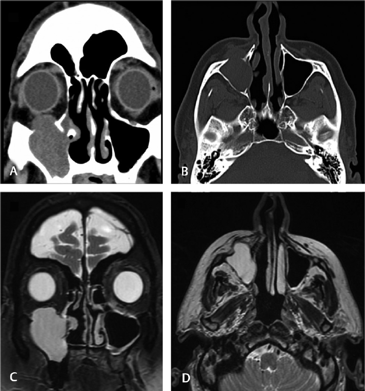 (A) (coronal plane computed tomographic (CT) image; soft tissue window): expansive soft tissue density lesion originating in the right maxillary sinus and intraorbital component, causing right eye hypertropia. (B) (axial plane CT image; bone window): totally opacified right maxillary sinus; bulging of the lateral nasal wall; dehiscent anterior maxillary sinus wall; limited subcutaneous component of the homogeneous lesion; signs of inferior turbinectomy. (C) (coronal plane T2 magnetic resonance imaging (MRI) scan): hyperintense expansive maxillary lesion with intraorbital component that modulates inferior rectus and oblique muscles. (D) (axial T2 MRI scan): hyperintense lesion protruding through the dehiscent anterior sinus wall.