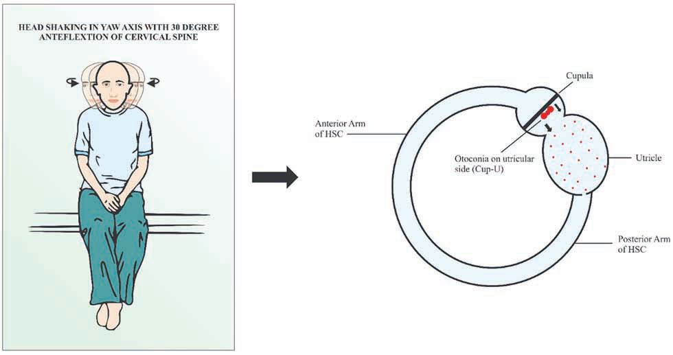 Head-shaking maneuver (HSM). The head is anteflexed 30 degrees in the pitch plane and briskly shaken by the excursions of 30 degrees side-to-side at an approximate rate of 3 Hz in the yaw axis for approximately 30 seconds