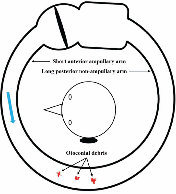 Forced prolonged positioning (FPP) in left lateral recumbent position for 1 hour. The patient is positioned left lateral recumbent for 1 hour. In the left lateral recumbent FPP, the otoconial debris (in red), which has either detached or loosened from the canal side of the cupula, migrates (blue arrow) within the short ampullary anterior arm of the canal toward its posterior end