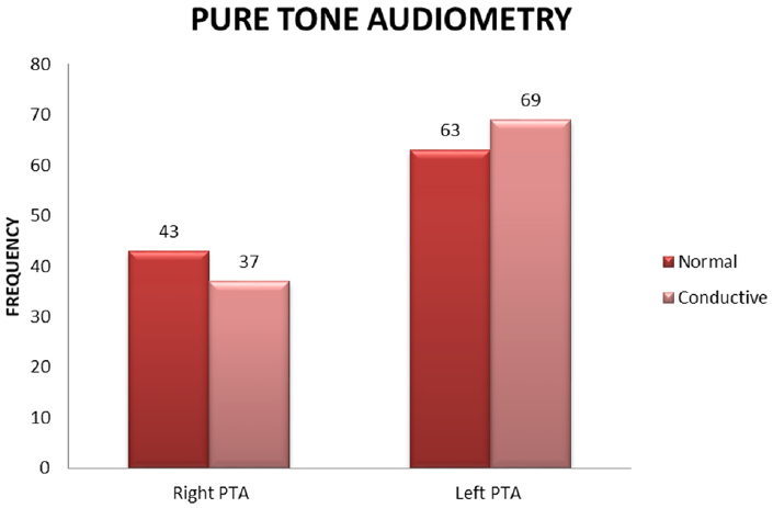 Distribution of pure tone audiometry (PTA) among the students in the clinically suspected cases of otitis media