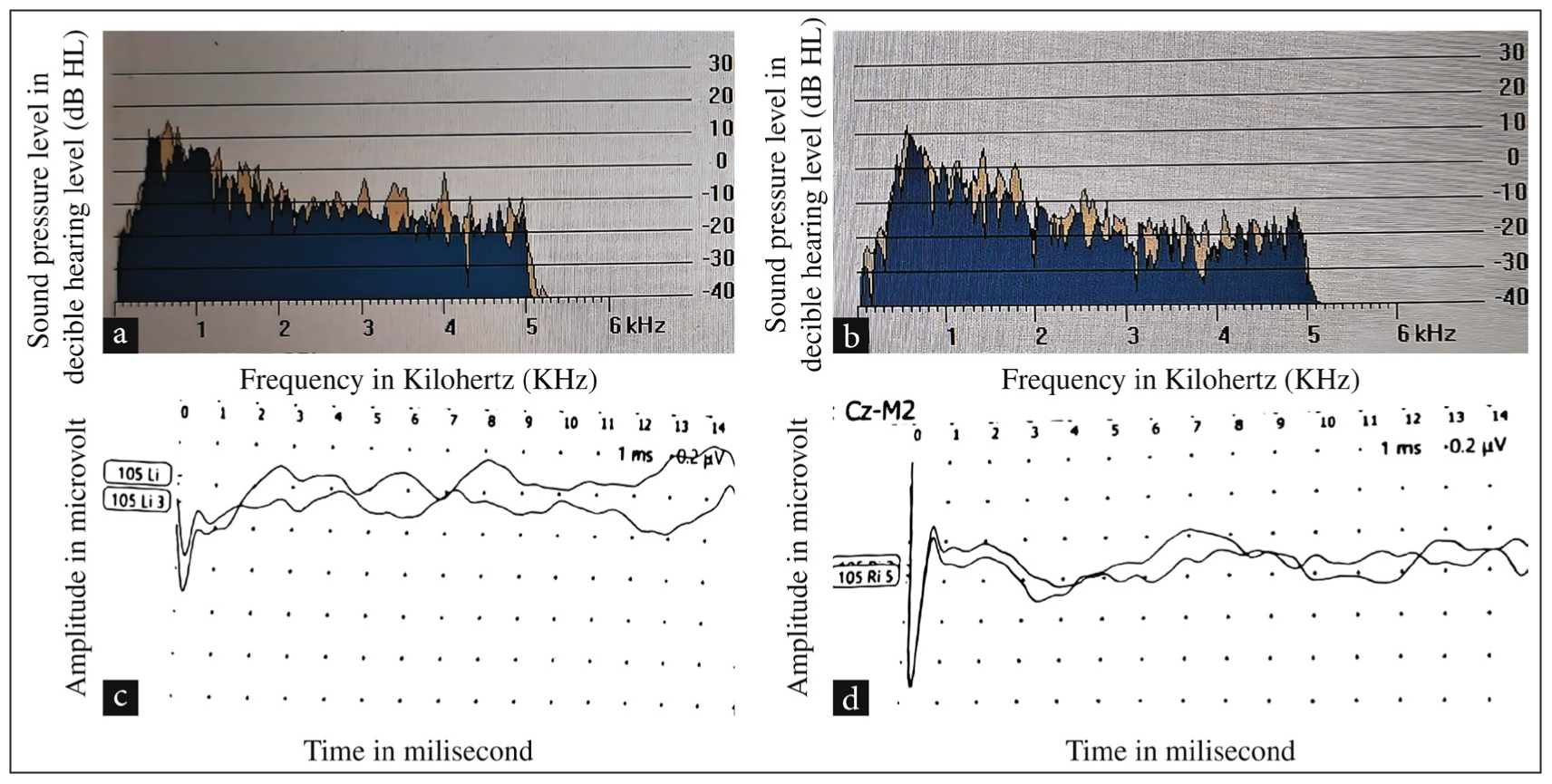 (a) Photograph of transient evoked OAEs was present in the right ear of Twin A. (b) Photograph of transient evoked OAEs in the left ear of Twin A. (c) Photograph of Brainstem Evoked Response Audiometry showing Vth peak absent at 105 dB HL in the right ear of Twin A. (d) Photograph of Brainstem Evoked Response Audiometry showing Vth peak absent at 105 dB HL in the left ear of Twin A. OAE: Otoacoustic emissions, db HL: Decibel hearing level.