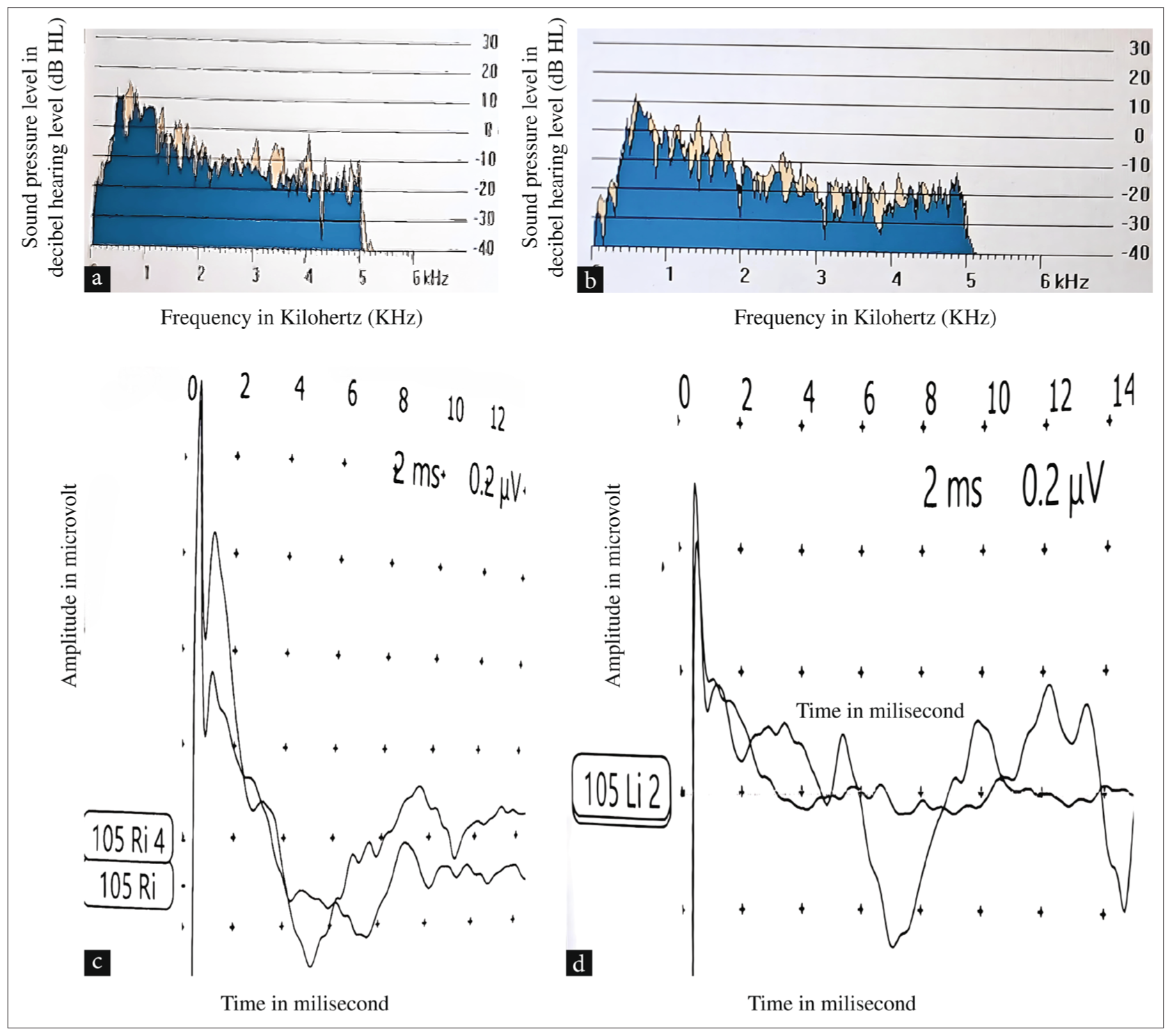 (a) Photograph of transient evoked OAEs was present in the right ear of Twin B. (b) Photograph of transient evoked OAEs in the left ear of Twin B. (c) Photograph of Brainstem Evoked Response Audiometry showing Vth peak absent at 105 dB HL in the right ear of Twin B. (d) Photograph of Brainstem Evoked Response Audiometry showing Vth peak absent at 105 dB HL in the left ear of Twin B. OAE: Otoacoustic emissions, db HL: Decibel hearing level.
