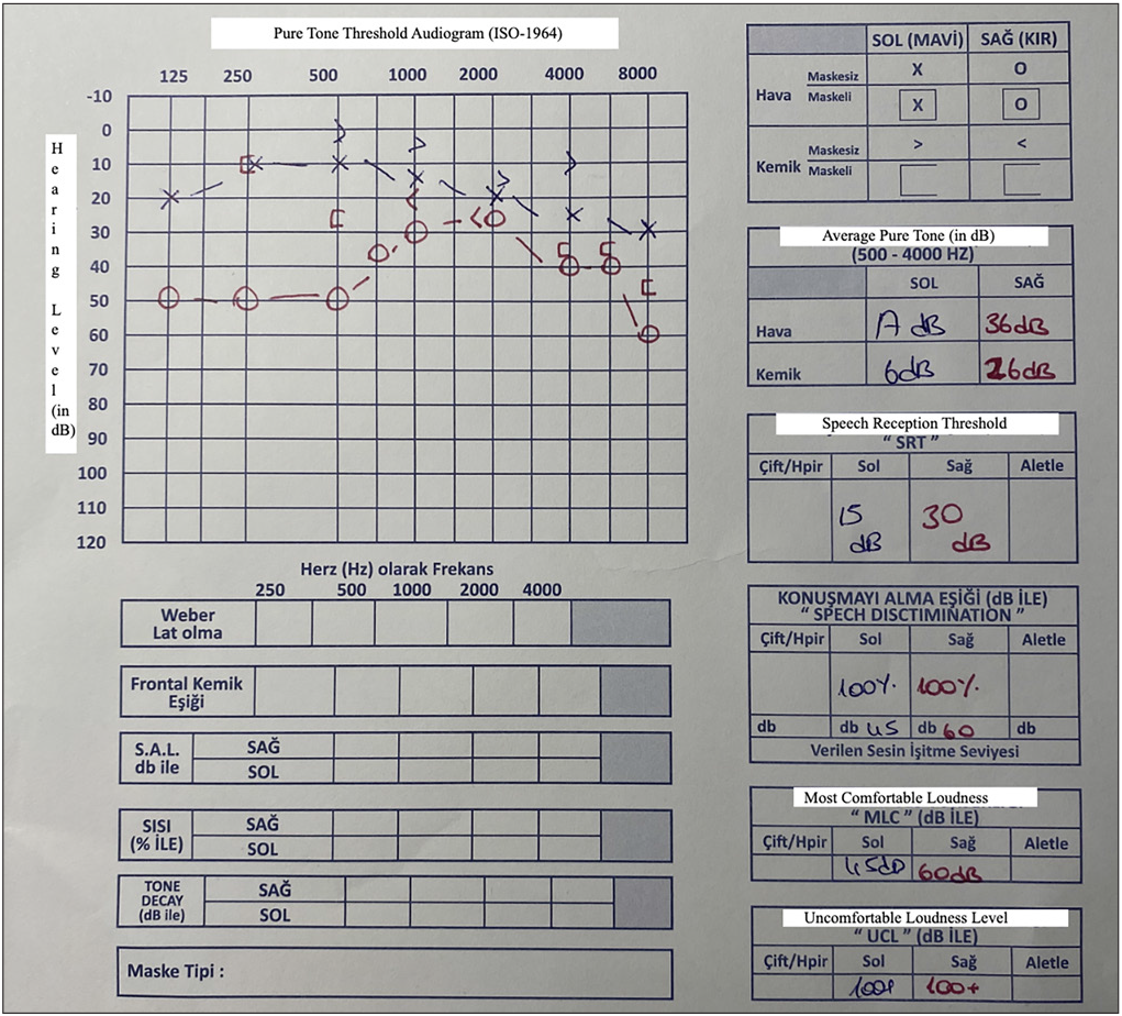 Pre-treatment audiological evaluation. SAG: Right, SOL: Left, SRT: Speech reception threshold, MCL: Most comfortable loudness, UCL: Uncomfortable loudness level, dB: Decibel.