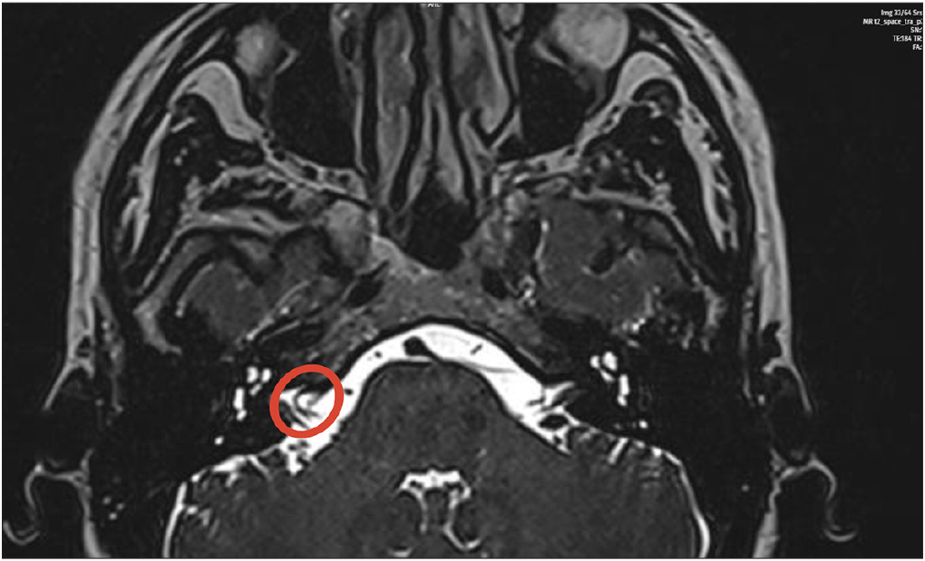 Radiological examination demonstrated that the right AICA extends into the IAC, and the findings are significant for a vascular loop (red circle). AICA: Anterior inferior cerebellar artery, IAC: Internal auditory canal.