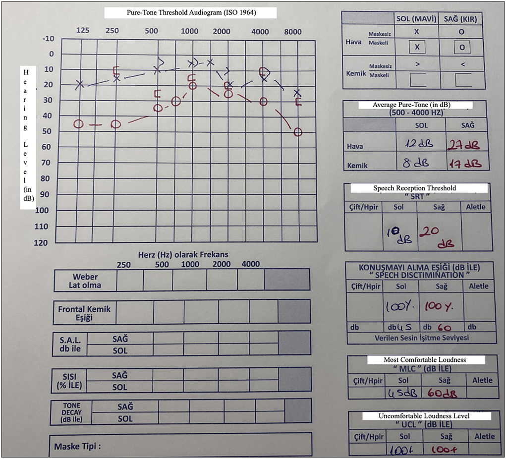 2 months after the treatment, audiological evaluation. ISO: International organization for standardization, SOL: Left, SAG: Right, SRT: Speech reception threshold, MLC: Most comfortable loudness.